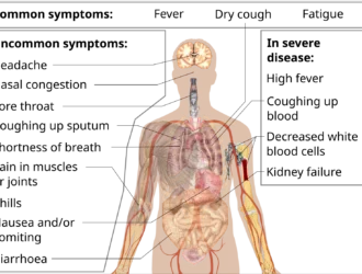 Early COVID symptoms in 2025